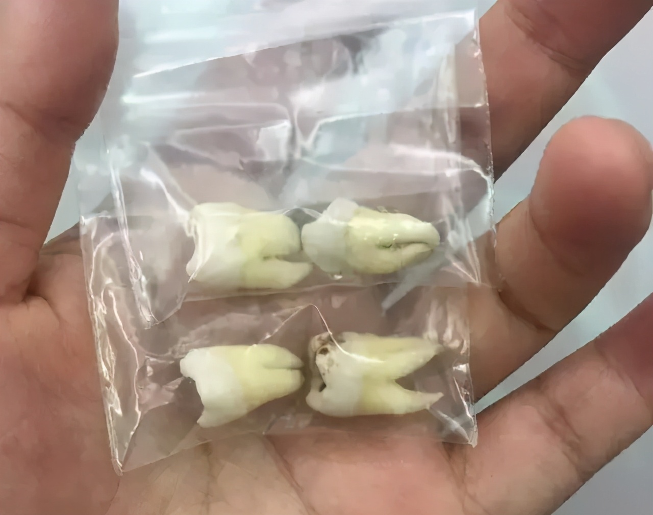 拔牙后什么时候冰敷什么时候热敷,拔牙前24小时冰敷24小时后热敷
