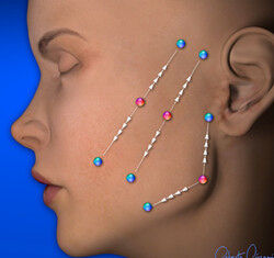 浙江阿姨拉皮手术,经典拉皮手术