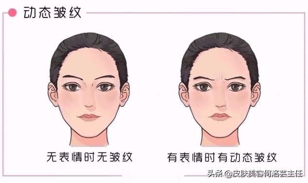 脸上有皱纹最快的去皱方法,脸上的皱纹用什么办法去皱效果好