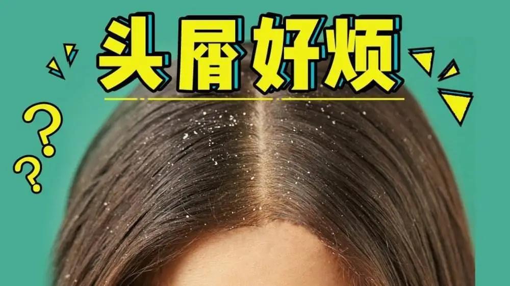 脂溢性皮炎头皮屑能治愈吗,脂溢性皮炎怎么根治头皮屑