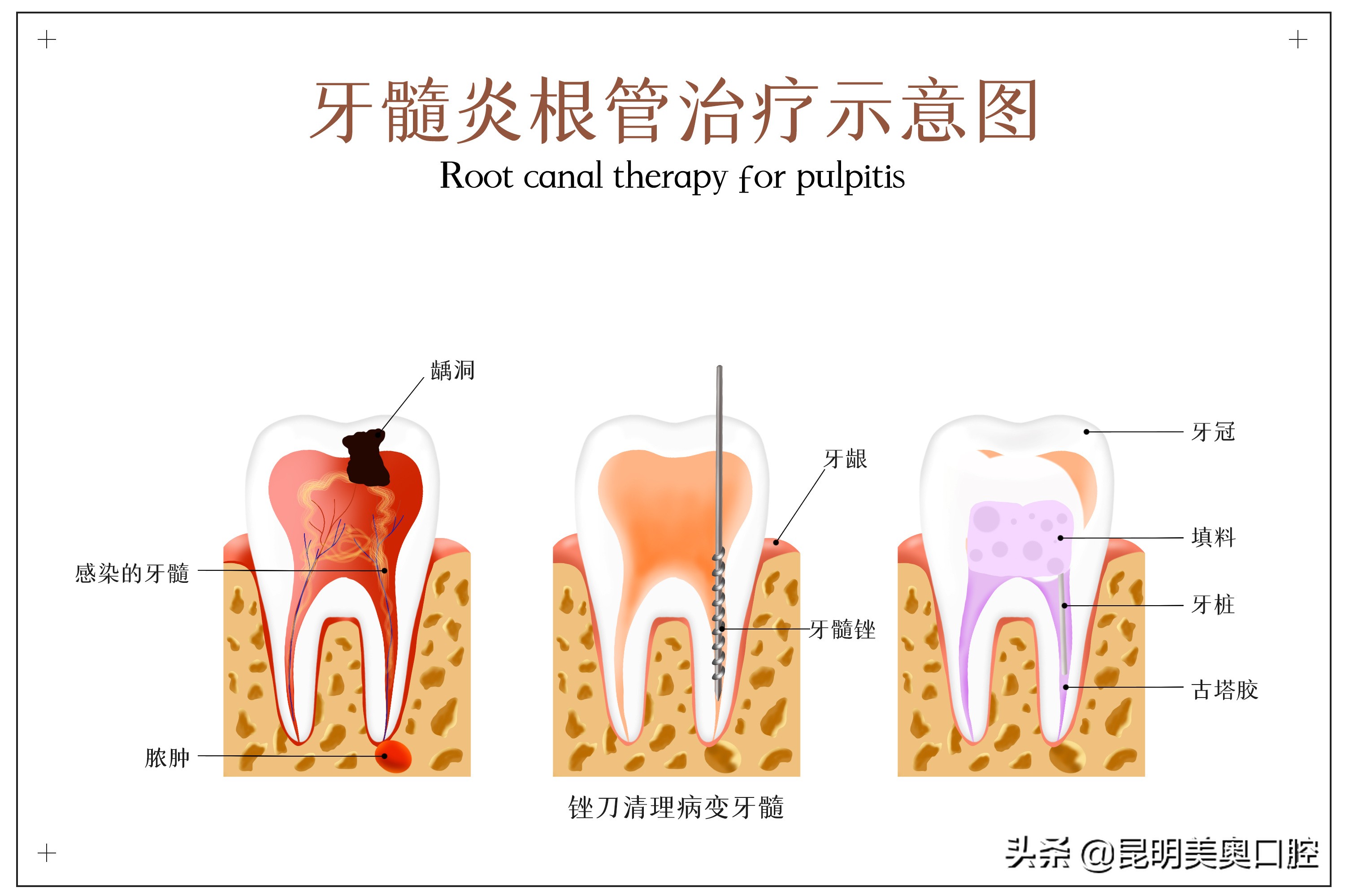 牙痛有哪些症状和治疗方法,引起牙痛的原因以及治疗方法
