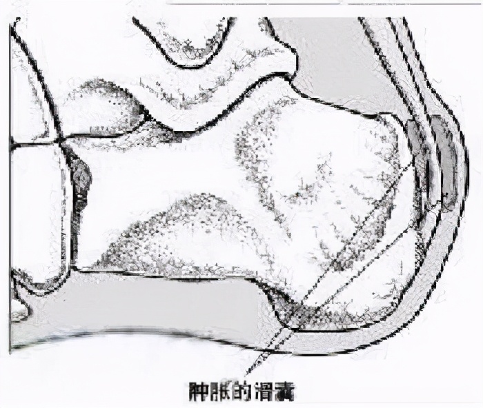 滑囊炎跟滑膜炎的区别是什么,滑囊炎和滑膜炎怎样区别