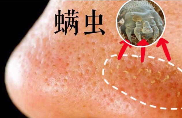 怎么分清螨虫导致的毛孔粗大,毛孔内螨虫怎么解决