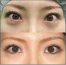 这个你察觉不到的小手术，滨崎步和80%的日本女星都做过它