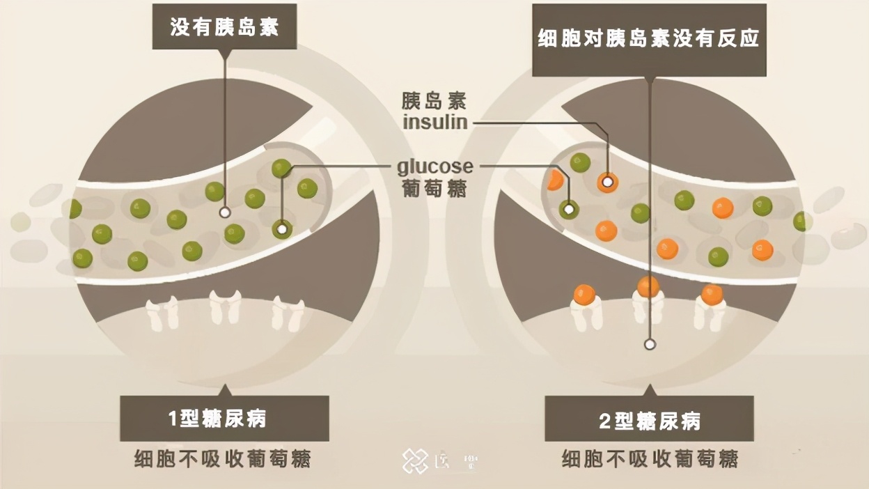 年轻人怎么避免糖尿病并发症,干细胞治疗糖尿病并发症