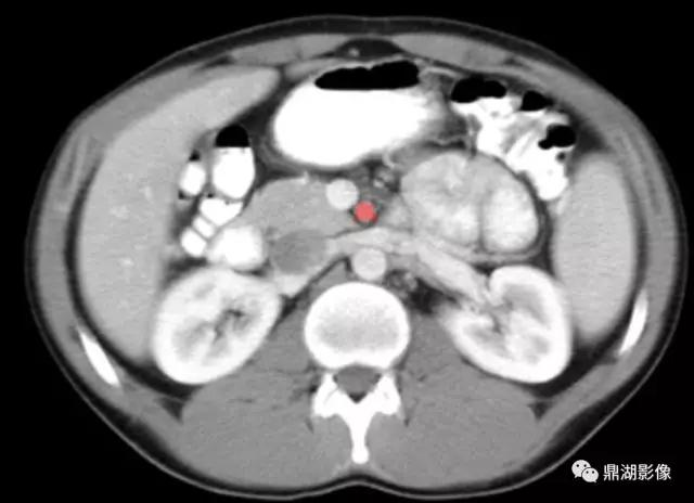 颈部胸锁乳突肌ct断层解剖图,骨盆骨质正常断层ct解剖图解