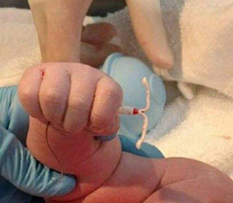 生完孩子必须上环吗,生完孩子以后上环是正确的吗