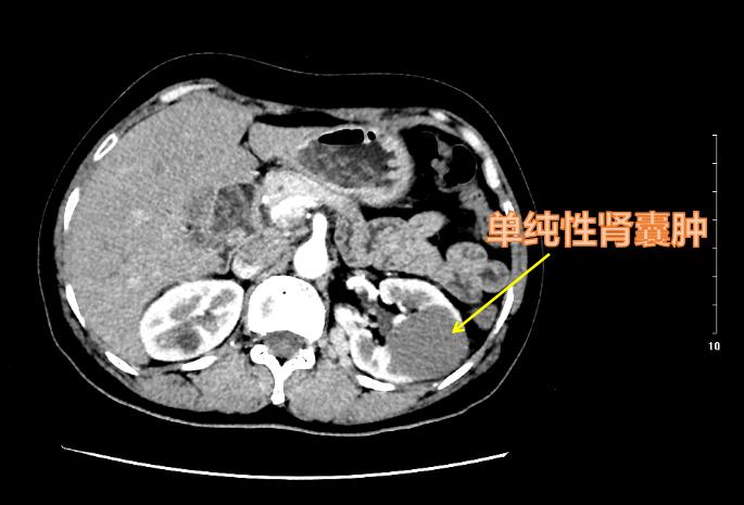 肾囊肿囊壁伴有钙化是肾癌吗,囊性肾癌是由复杂囊肿变化的吗