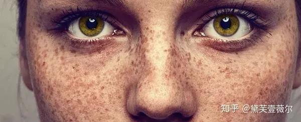 雀斑是怎样形成的用什么方法除去,雀斑能去掉吗五个消除雀斑的方法