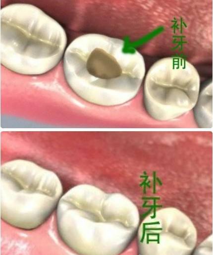 北京精德口腔详解要不要洗牙,精德口腔北京