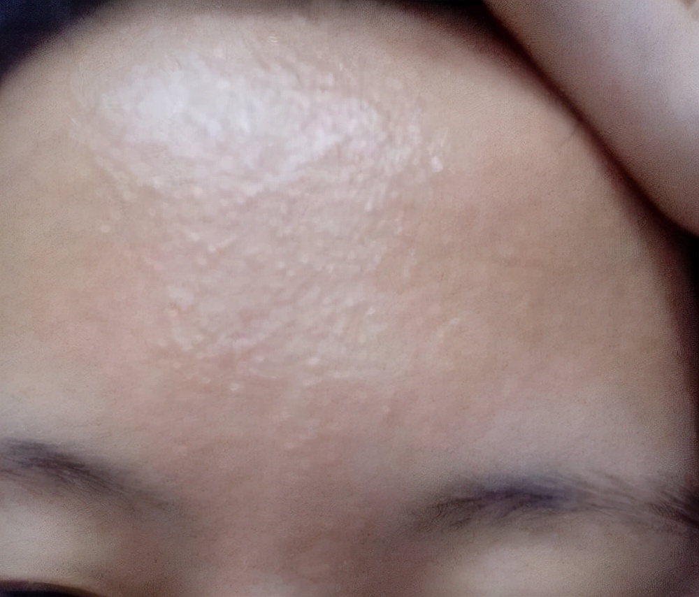 皮肤不光滑很多小颗粒怎么办,皮肤起密密麻麻小颗粒不痛不痒