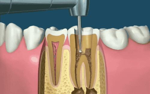 各类口腔治疗后的注意事项,口腔养护的基本方法和操作