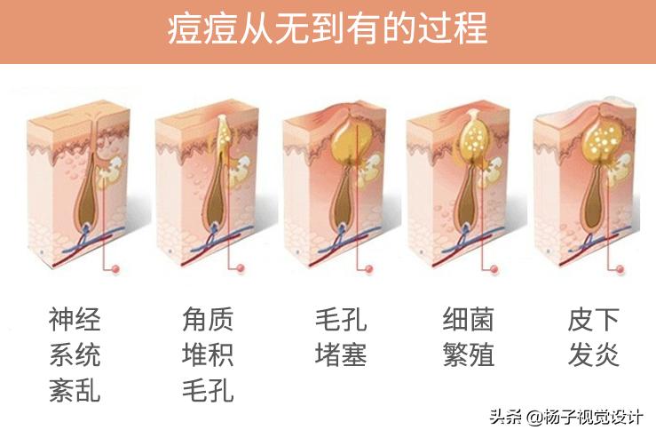 脸上长痘痘特别严重怎么快速消除,脸上长痘痘怎么办快速解决图片