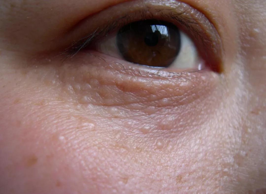 脂肪粒跟肿瘤的区别,脂肪粒也是肿瘤吗