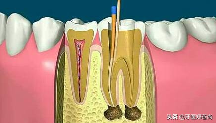 根管治疗不彻底后又蛀牙,根管治疗修复蛀牙