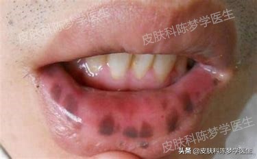 色斑和褐斑,根治面部黑褐斑的方法