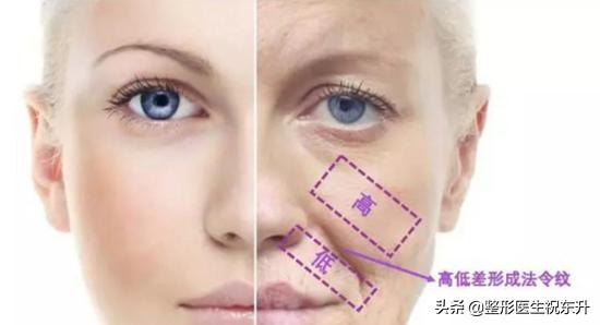 年龄大的怎样遮眼袋法令纹,脸上的法令纹怎么就快速去除了
