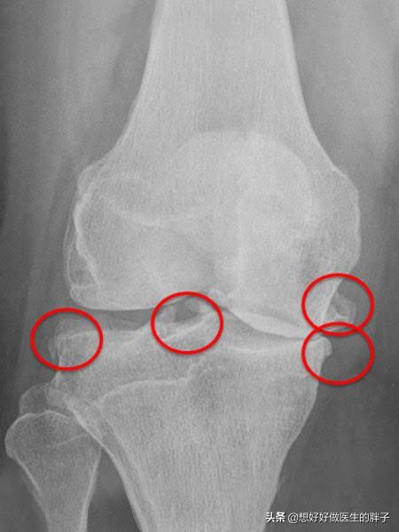 膝盖有骨刺自我疗法,膝盖有骨刺的物理治疗