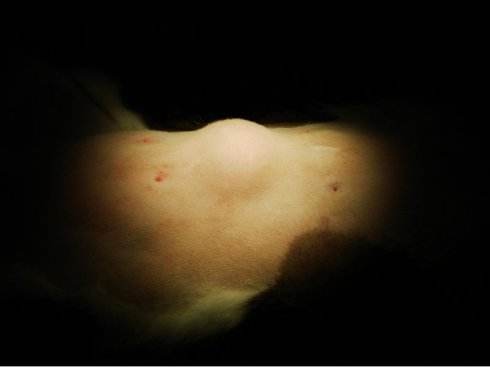 身上长了「脂肪瘤」要不要手术切了？骨科医生：你需要知道这4点