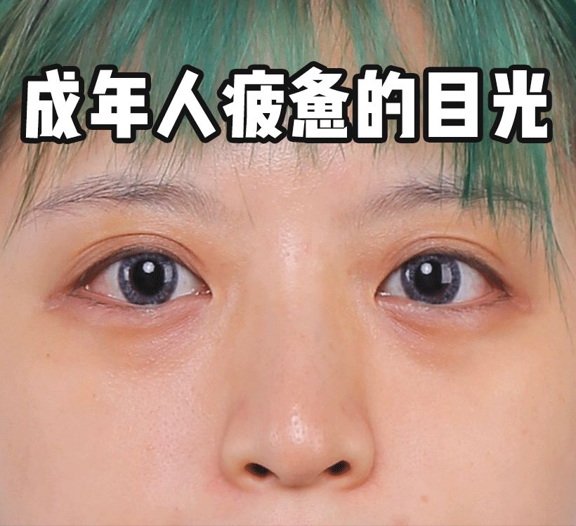 一次就能让黑眼圈消失的办法,一针下去瞬间没了黑眼圈