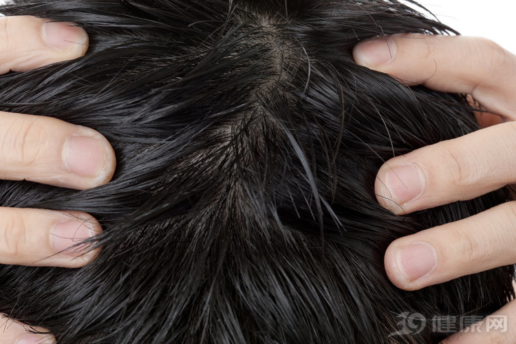一天不洗头头发上都是头皮屑,一天不洗头就满头头皮屑怎么办