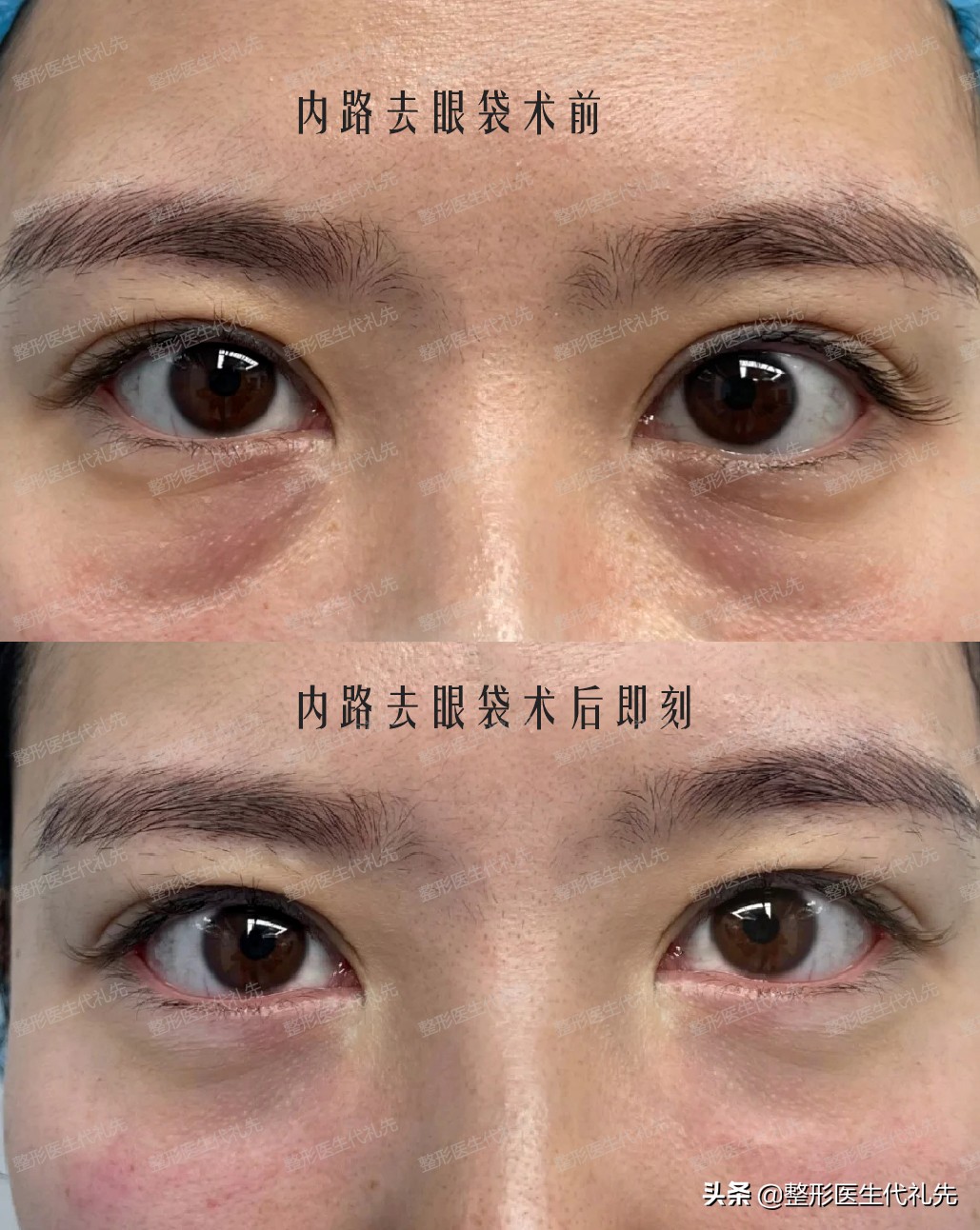 不开刀祛眼袋和开刀祛眼袋哪个好,微创祛眼袋和手术开刀哪种效果好