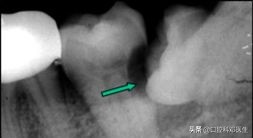 别让一颗牙齿毁了一张脸？医生说95%的人都有这样的牙齿！