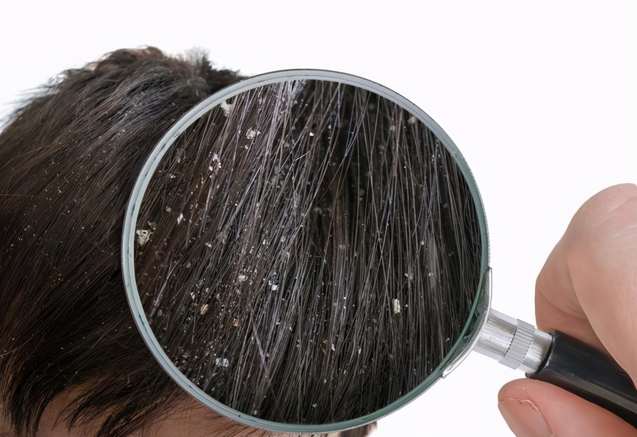 脂溢性皮炎患者怎么保护皮肤,脂溢性皮炎发展到皮肤病了怎么办