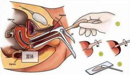 宫颈癌筛查是阴道镜活检准不,宫颈癌筛查是阴道镜活检么