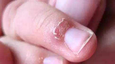 红霉素软膏治什么病最便宜,红霉素软膏价格不同效果不一样吗