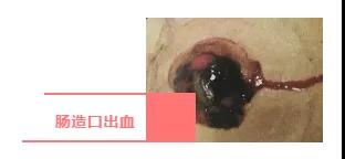 墙裂建议收藏！肠造口回缩，脱垂，旁疝，出血，水肿你会处理吗？