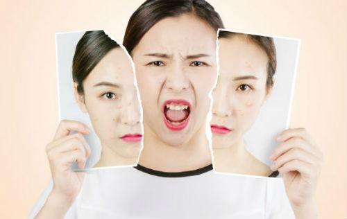 祛痘痘黑印用什么药,激光祛痘痘留下黑印子怎么办