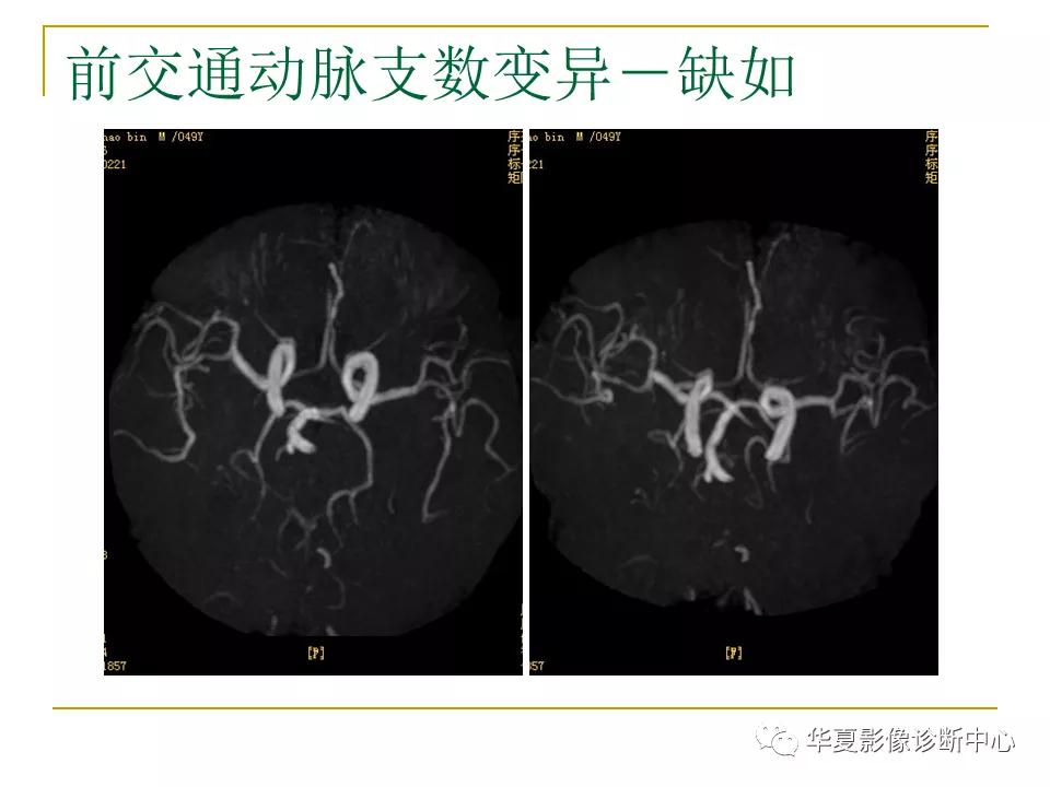 中国人脑立体定向mri应用解剖图谱,脑mri示意图