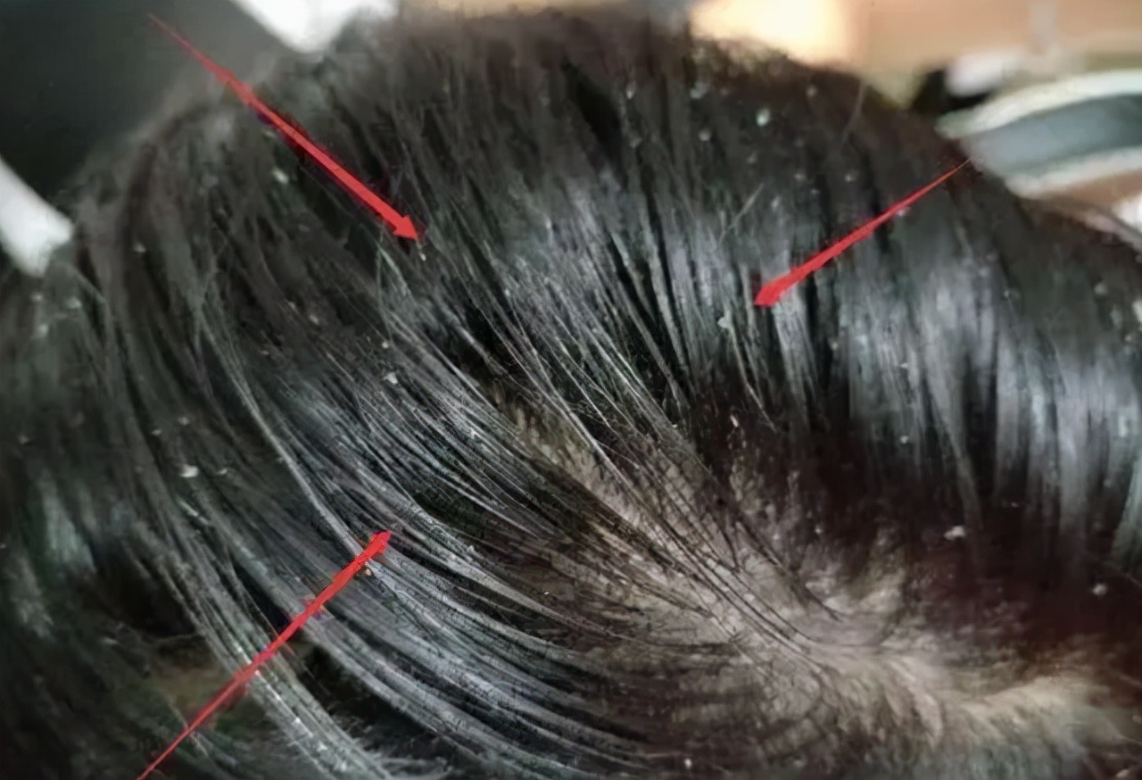 头皮上长红疙瘩脓包用什么药,头皮有疙瘩脓包痒痒