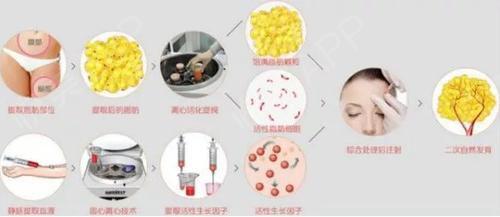 自体脂肪填额头部可以维持多久,自体脂肪填充需要了解什么