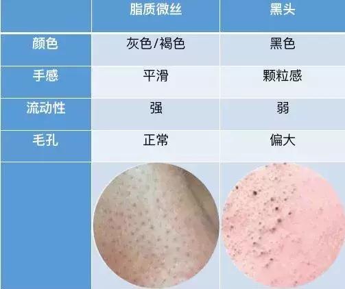 黑头为什么一直去不掉,黑头为什么总是去不掉