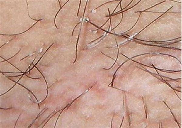 毛发稀疏是天生的吗,毛发稀疏代表什么