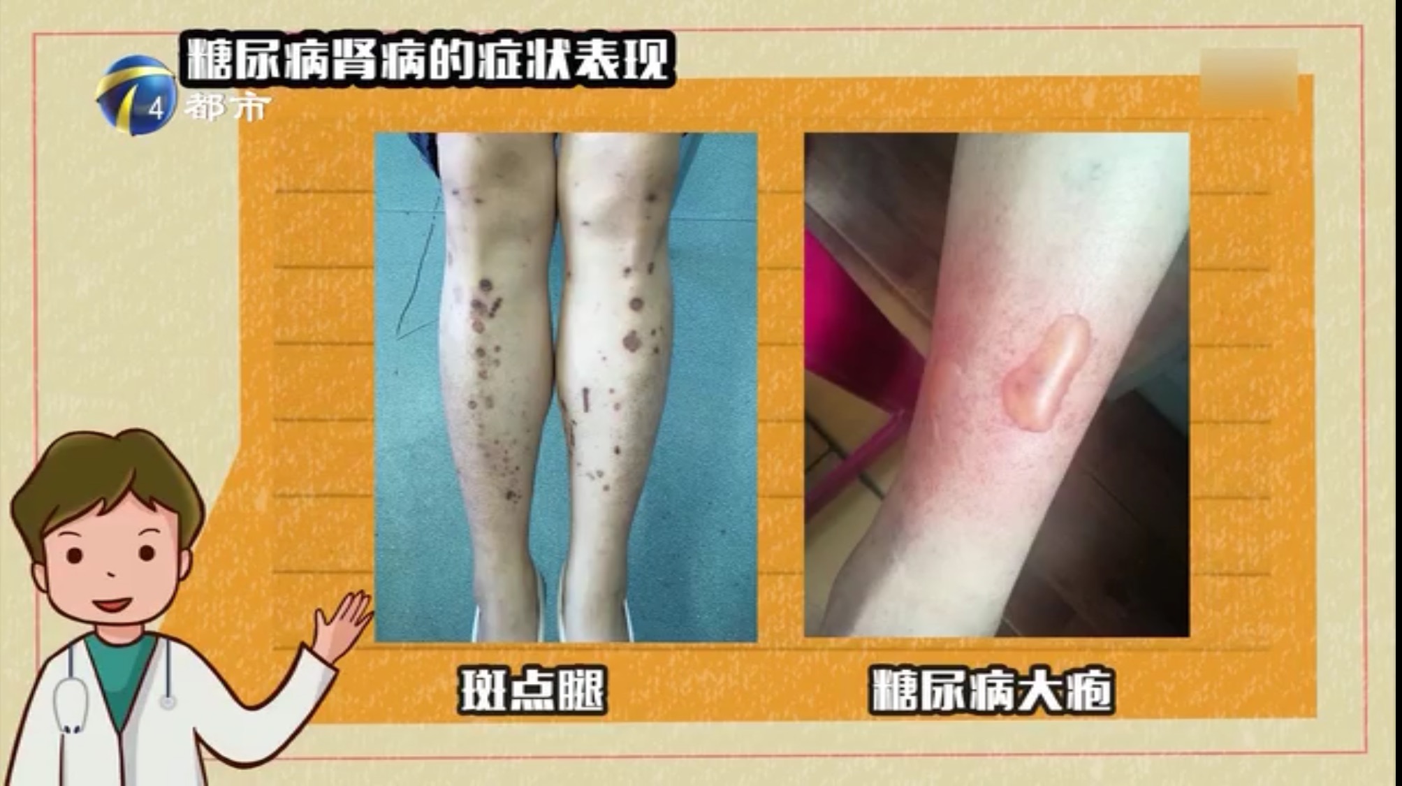 尿里有水纹是糖尿病吗,尿中带泡沫是什么病