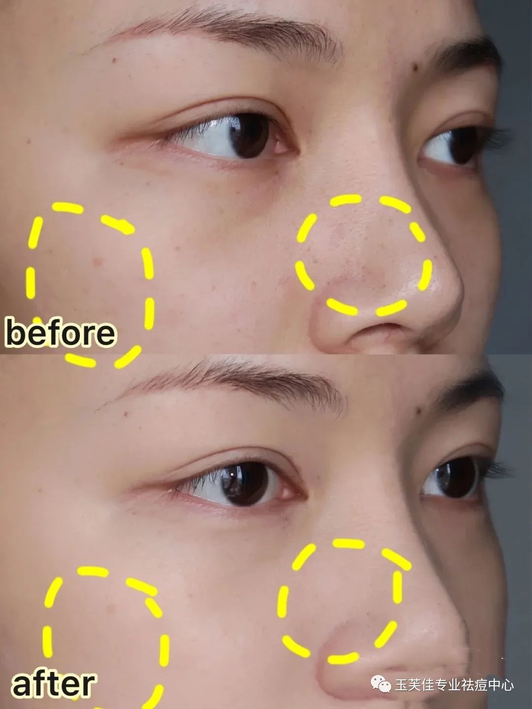 痘痘肌化妆教程用什么颜色遮瑕,痘痘肌化妆教程初学者淡妆