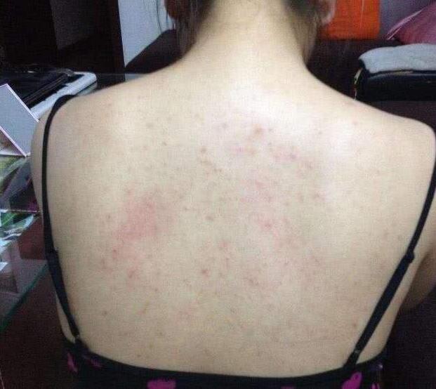 后背长痘痘的原因和解决方法图文,后背长痘痘如何正确有效解决