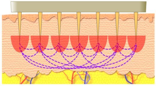 因肥胖撑出的纹怎么去除,因为肥胖导致的胖纹怎么消掉