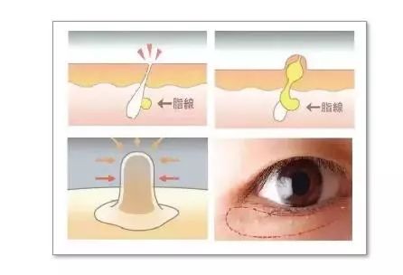 脂肪粒的形成是因为缺少维生素嘛,眼周围的脂肪粒的形成原因是什么