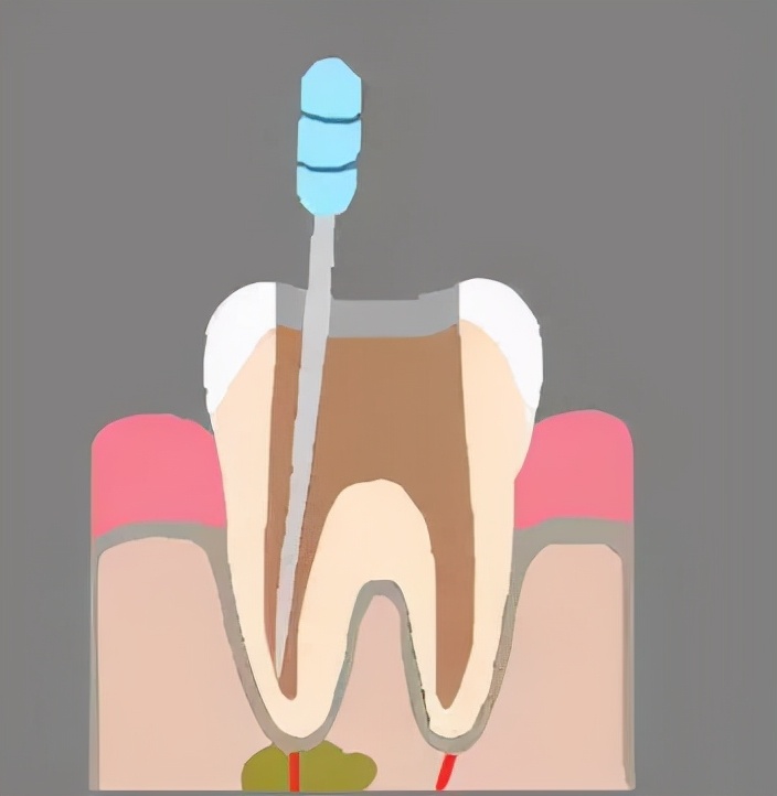 做根管治疗需要注意饮食,根管治疗不当的后果