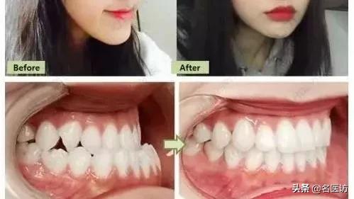 牙齿矫正不戴保持器会全部反弹吗,牙齿矫正保持器戴久了脸会变形吗