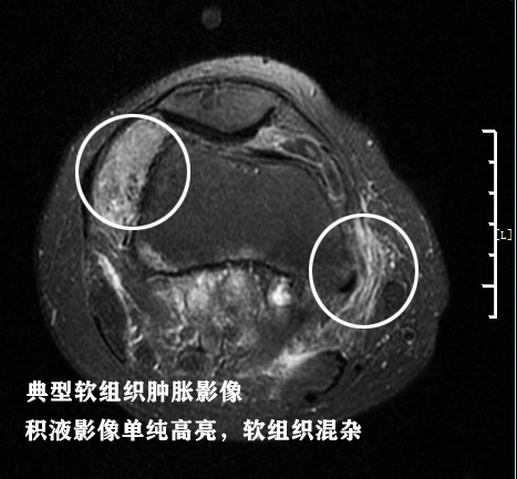 怎样能看懂膝关节核磁图片,如何看懂膝关节磁共振报告