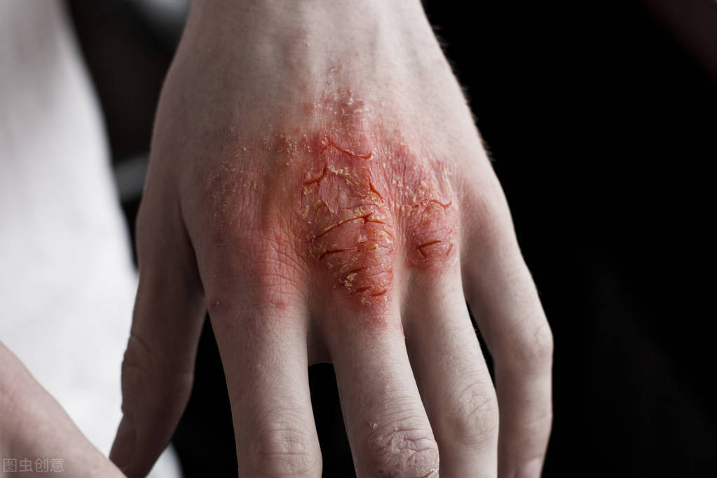 治疗反复发作湿疹打什么封闭针好,湿疹反复小偏方