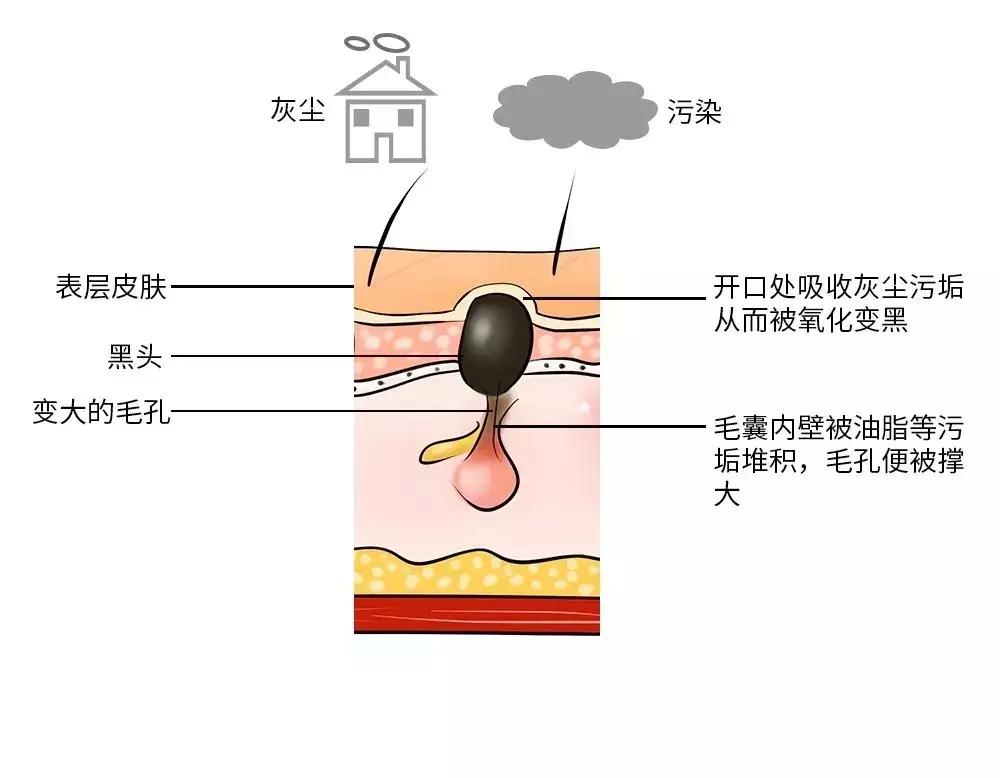 有黑头又泛红的草莓鼻怎么办,如何用医美去除草莓鼻和黑头