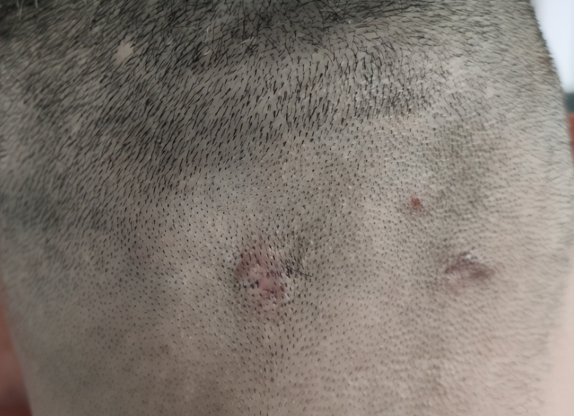 脖颈毛囊炎硬疙瘩怎么消除,脖颈毛囊炎的症状和图片