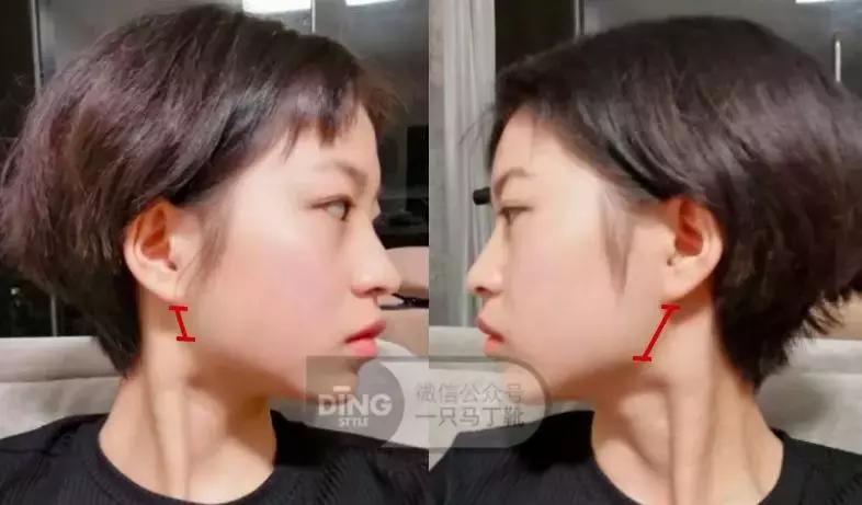 脸大小不对称怎么矫正,如何改善大小脸不对称