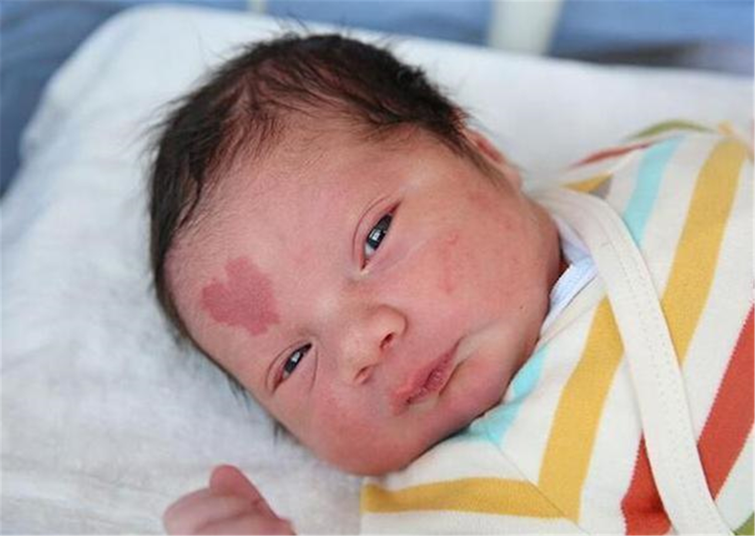 胎儿长胎记是怎么导致的,胎儿容易长胎记的原因是什么